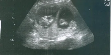 УЗИ во время беременности - Гравимед